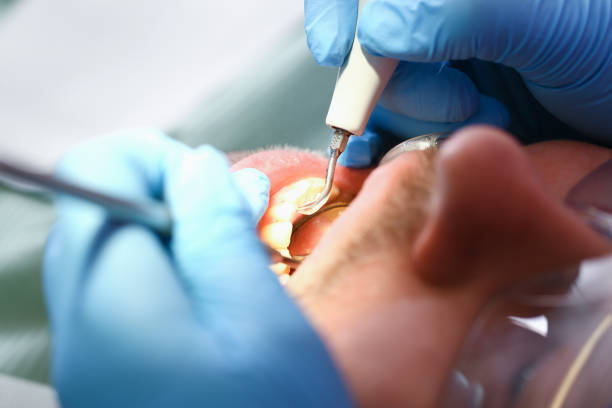 Best Emergency Tooth Extraction in Hidalgo, TX